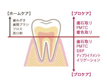 ホームケア:歯みがき,歯間ブラシ,フロス,洗口剤　プロケア:歯石取り,PMTC,着色取り,SRP,ディブライドメント,イリゲーション