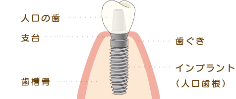 インプラントの仕組みのイラスト